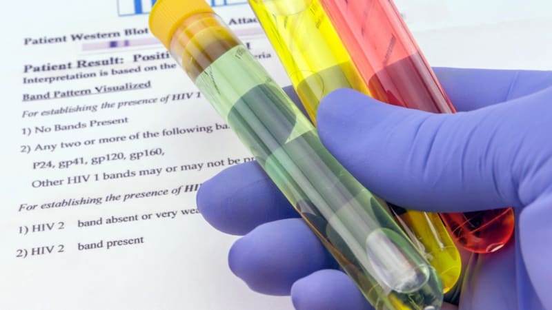 Česko směřuje k rekordu v počtu nakažených HIV. Lékaři popsali, co tento nárůst způsobilo